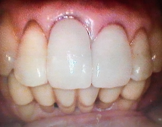 ジルコニア前歯部