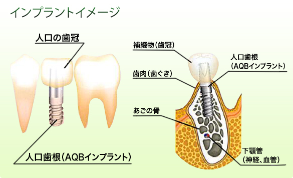 インプラントイメージ