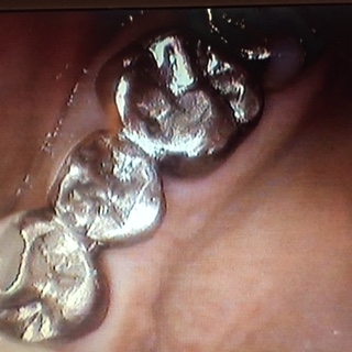 金属の歯